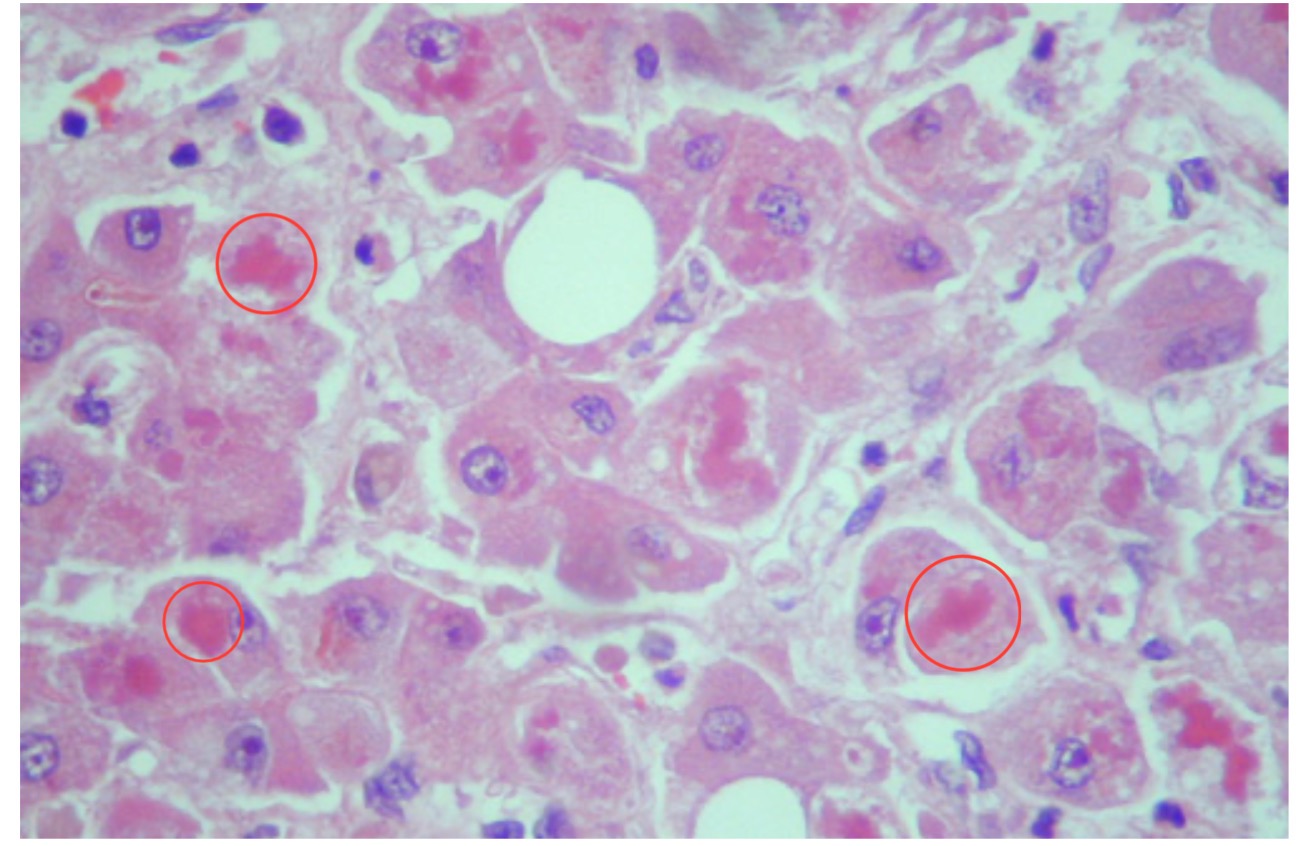 <p>Histological Section of the Liver containing cytoplasmic organelle damage. Identify the red globular material encircled. Identify type of intracellular accumulation.</p>