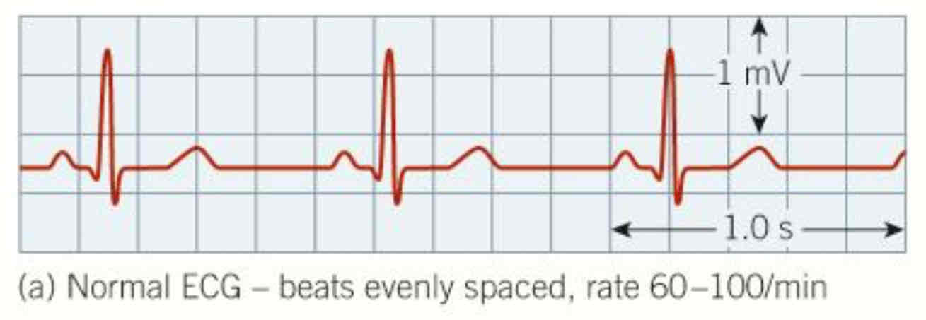 <p>beats evenly spaced 60-100min^-1</p>