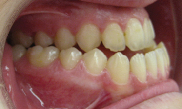 <p>Class III Malocclusion </p>