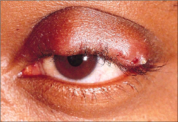 <ul><li><p>External hordeolum (stye)</p></li></ul><p>—> lash follicle + associated with gland of<strong> Zeiss or Moll</strong> - bass of eyelash</p><p></p><ul><li><p>internal hordeolum - further in lid (image)</p></li></ul><p>—><strong> meibomian gland</strong> - tarsal plate</p><p>treat as per blepharitis</p><p></p>