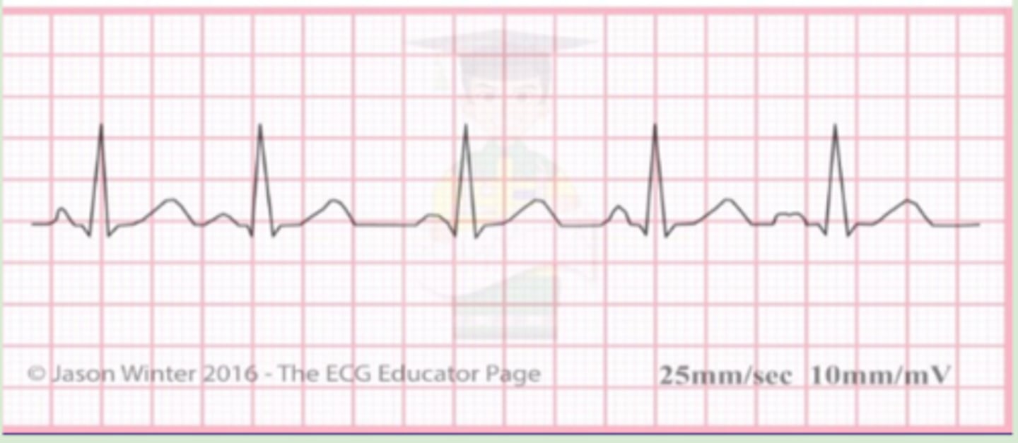 <p>Originate: AV node</p><p>QRS complex: narrow</p><p>P wave: at least 3 different waves</p><p>Heart rate: &lt;100 bpm</p><p>R-R intervals: regular</p>