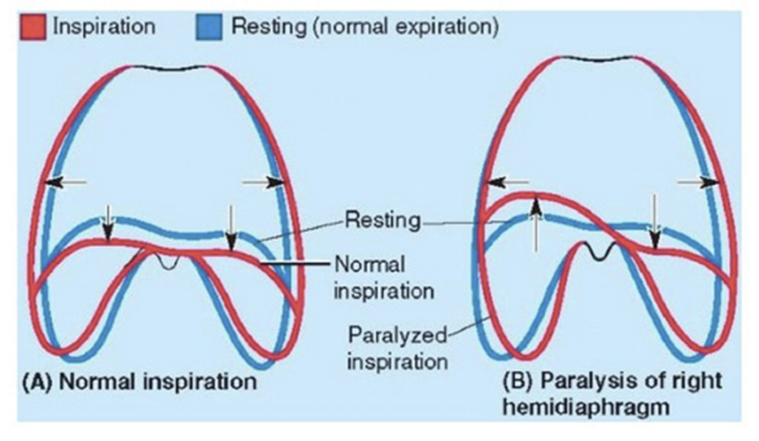 <ul><li><p>Paralysis of half of the diaphragm (one dome) due to injury to its motor supply from the phrenic nerve does <u>not</u> affect the other half because each dome has a separate nerve supply</p></li><li><p>We can detect paralysis radiographically by noting its paradoxical movement —</p><ul><li><p>Instead of descending as it normally does during inspiration (contraction), the paralyzed dome ascends as it is pushed superiorly by the abdominal viscera that are being compressed by the active contralateral dome —</p></li></ul></li><li><p>Instead of ascending during expiration, the paralysed dome descends in response to the positive pressure in the lungs </p></li></ul>
