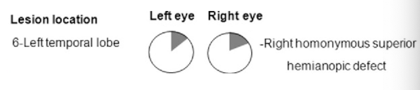 <p>temporal lope optic radiations lesion </p><p>right homonymous superior hemianopic defect (“pie in the sky”)</p>