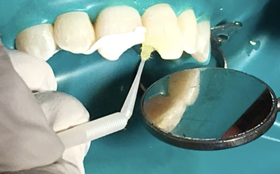 <p>This is a requirement for bonded restorations</p>