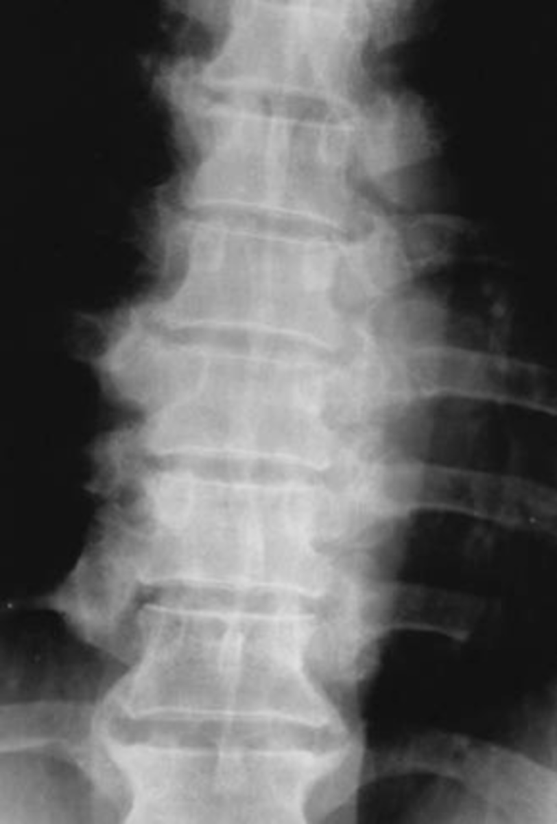 <p>ID type of degenerative spine disease in the thoracic spine</p>