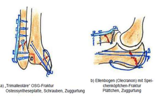 <p>Operative Frakturbehandlung</p><p><strong>Kombinationsosteosynthese</strong></p><ul><li><p>Verwendung mehrerer Materialien</p></li></ul><p></p>