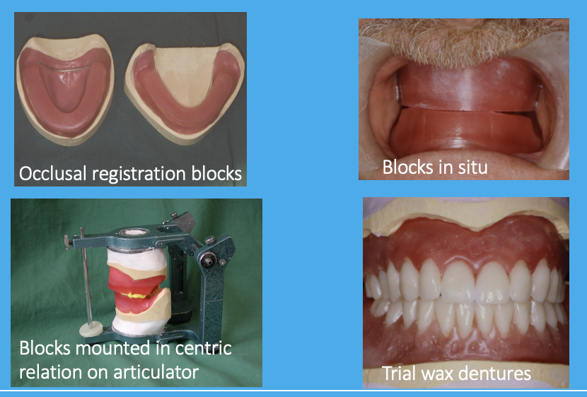 <ul><li><p>registration - visit 3</p></li><li><p>wax try-in - visit 4</p></li></ul><p></p>