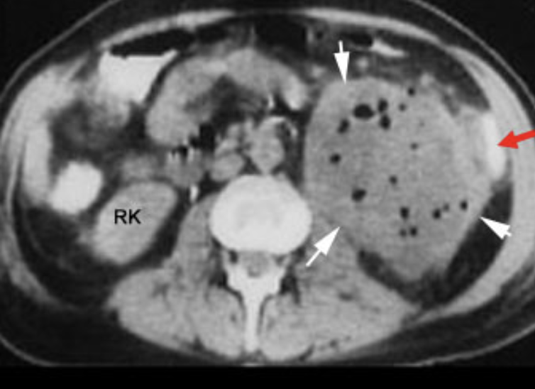 <p><em>CT Abdomen/Pelvis IV contrast</em></p>