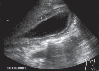 <p>Abd US &amp; CT, HIDA scan, blood cultures</p>