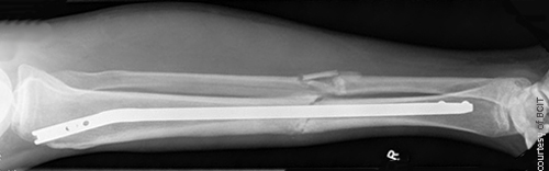 <p>IM nails (intermedullary)</p>