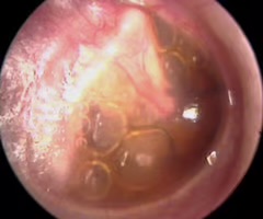 <p>air or fluid collected behind the tympanic membrane in the middle ear which causes the tympanic membrane to bulge.</p>