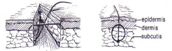 <p>What suture pattern is shown in the image?</p>