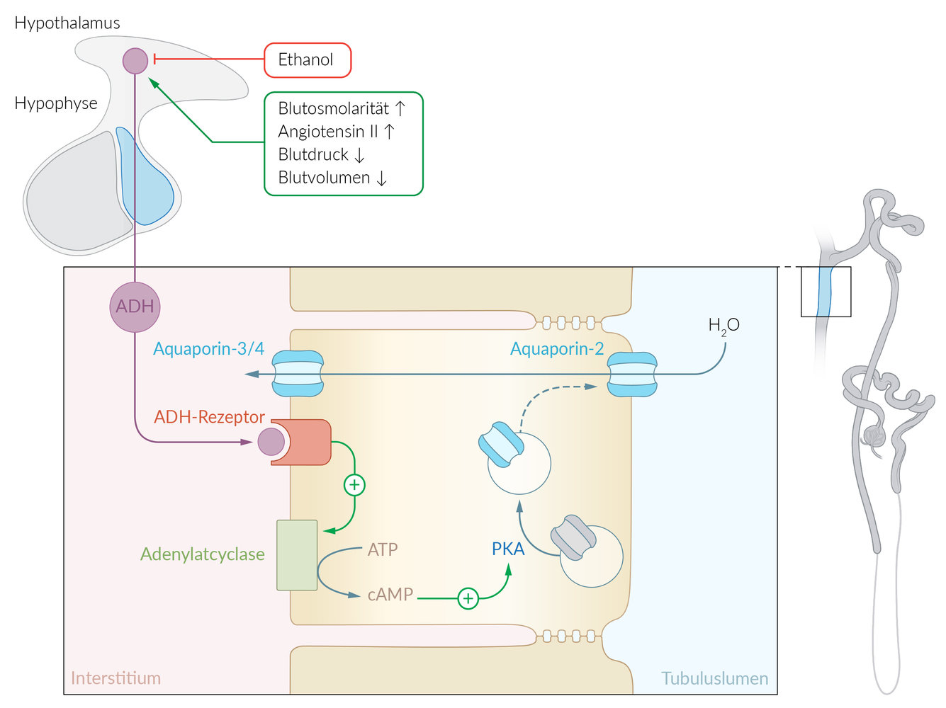 <p>C. Polyuria due to a congenital aquaporin-2 defect</p>
