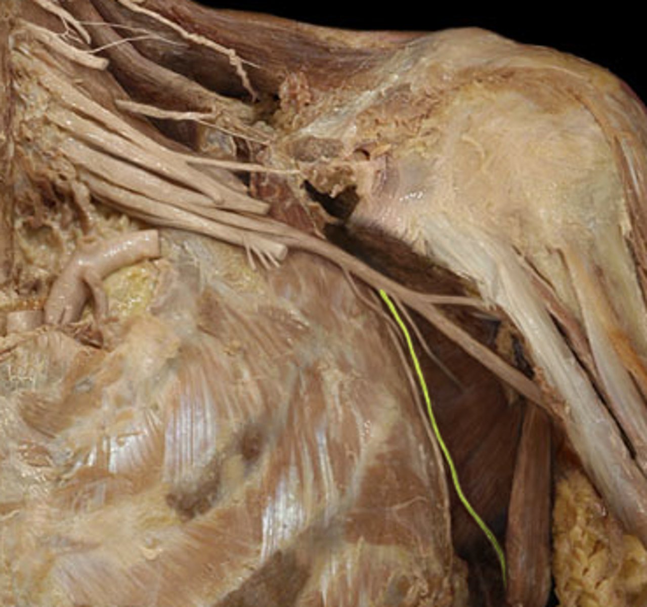 <p>latissimus dorsi innervating nerve</p>