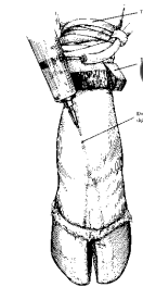 <p><span>Anesthesia of the Lower Limb (Bier Block)</span></p>