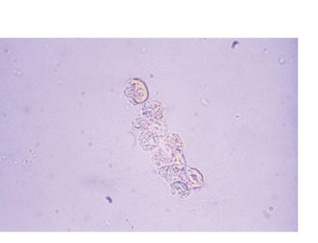 <p><span style="font-family: Arial, sans-serif">Renal Tubular Epithelial Cell Casts</span></p>