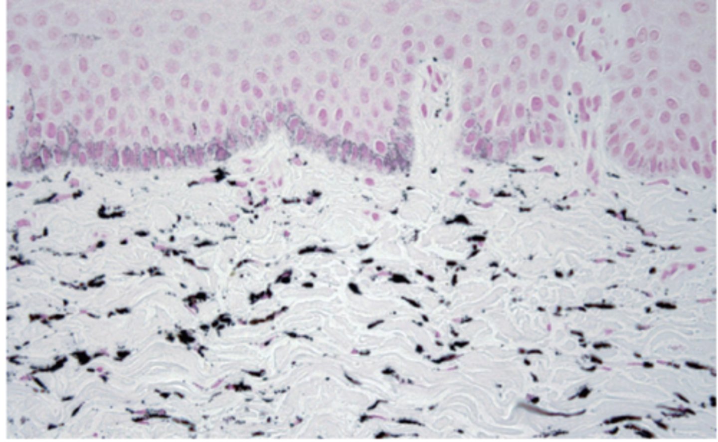 <p>What type of pigmentation has lots of pigmentation in collagen fibers and has melanocytes in basal cells?</p>