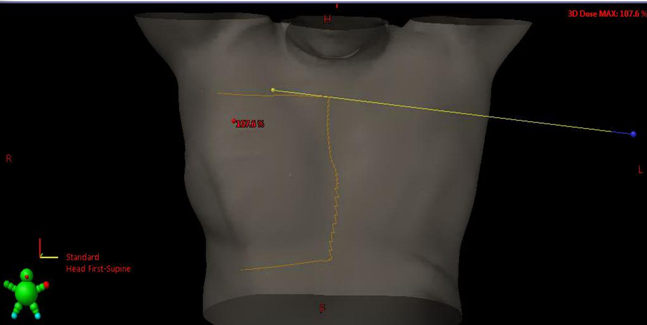 <p>where should the medial, superior and inferior borders lie on with the medial tangent field?</p>