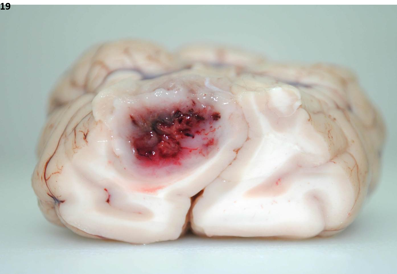 <p>19.&nbsp; Tissue from a dog.&nbsp; Which of the following immunostains is LEAST likely to be positive in this neoplasm?</p><ol type="a"><li><p>Doublecortin</p></li><li><p>Leu-7</p></li><li><p>GFAP</p></li><li><p><span>Olig-1</span></p></li></ol><p></p>