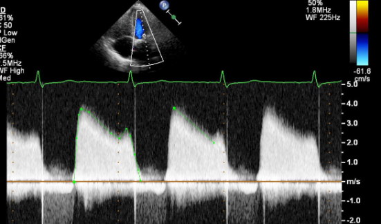 <p>Identify the spectral Doppler waveform:</p>