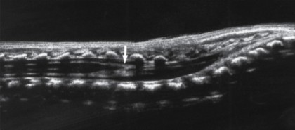 <ol><li><p>What plane was this image taken in?</p></li><li><p>The arrow points to the end of the conus medullaris, is this a normal location for it to end?</p></li></ol><p></p>