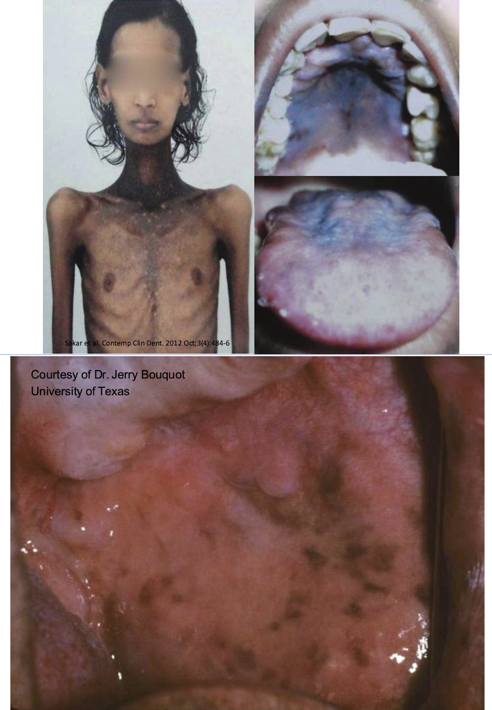 <p>which autoimmune melanin-associated pigmented lesion?</p>