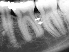 <p>what leads to appearance of double PDL space as shown in the image</p>