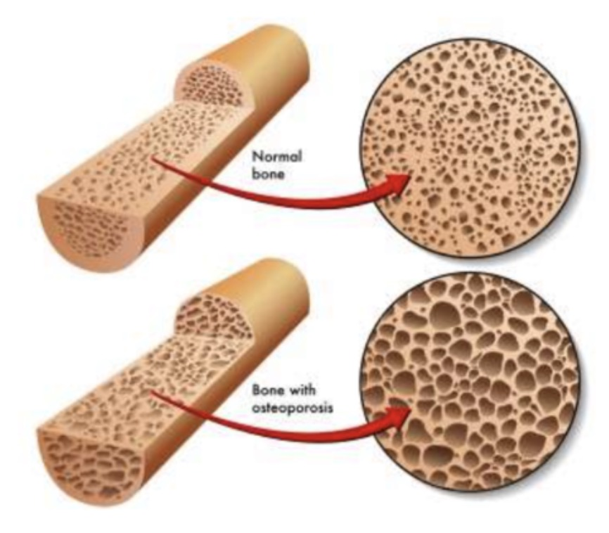 <p><br><span>Sjukdom som ger en minskad benmassa orsakad av en obalans som lutar mot resorption</span></p><p></p>