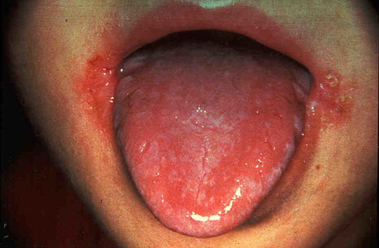 <p>RARE</p><p>- Dermatitis</p><p>- Glossitis - inflammation of the tongue</p><p>- Cheilosis - cracking of mouth</p><p>- Angular stomatitis - painful sores at the corners of the mouth</p><p>- Peripheral neuropathy (unique!)</p><p>- Seizures</p><p>- Hypochromic microcytic anemia; due to lack of heme synthesis</p>