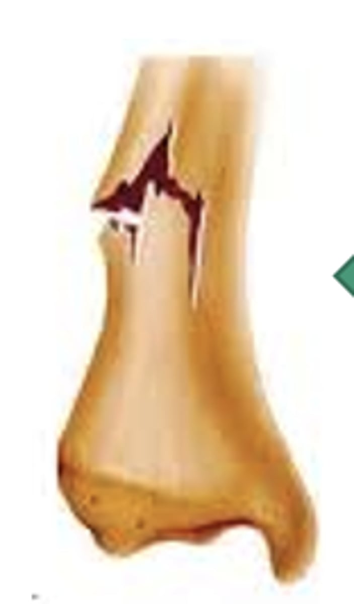 <p>seen in children, partial break in bone continuity</p>