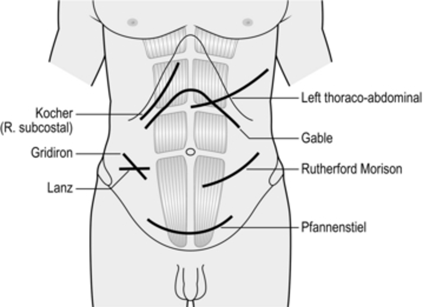 <p>Kocher Incision (subcostal)</p>