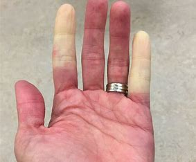 <p><span>= episodes of abrupt, progressive tricolor change of the fingers in response to cold, vibration, or stress</span></p><ol><li><p><span>White (pallor) at the fingertips</span></p></li><li><p><span>Blue (cyanosis) in the lower figure</span></p></li><li><p><span>Red (rubor) in the heel of the hand</span></p></li></ol>