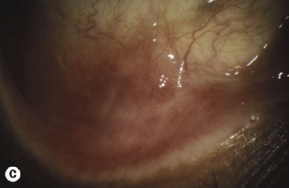 <ul><li><p>Conj: worse inferior</p><ul><li><p>Papillary conj reaction</p></li><li><p>Conj hyperemia</p></li><li><p>Horner-trantas dots</p></li><li><p>Conj scarring and symblepharon formation (lead to a shorten fornix and keratinziation of the caruncle)</p></li></ul></li><li><p>Cornea:&nbsp;</p><ul><li><p>PEE inferior 1/3 of cornea</p></li><li><p>Persistent epithelial defects, may have associated corneal thinning&nbsp;</p></li><li><p>plaques</p></li><li><p>peripheral vascularization with stromal scarring, more common with AKC than VKC</p></li></ul></li><li><p>Cataract: shield like anterior or posterior subcapsular cataract&nbsp;</p></li></ul><p></p>