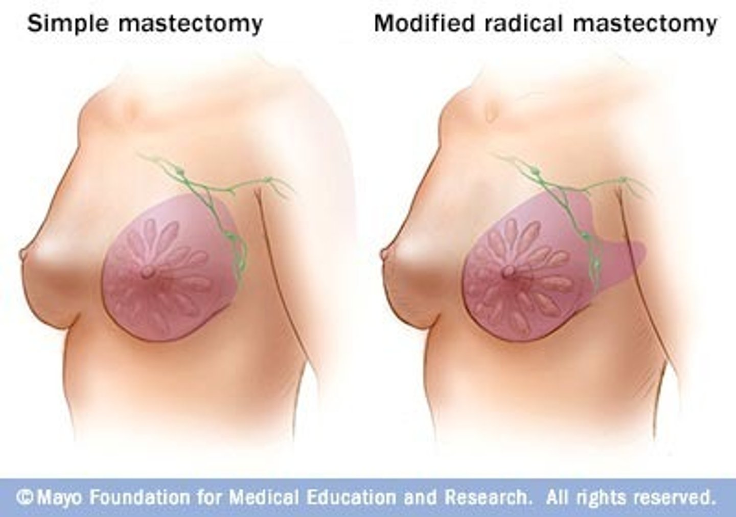 <p>surgical removal of the breast</p>