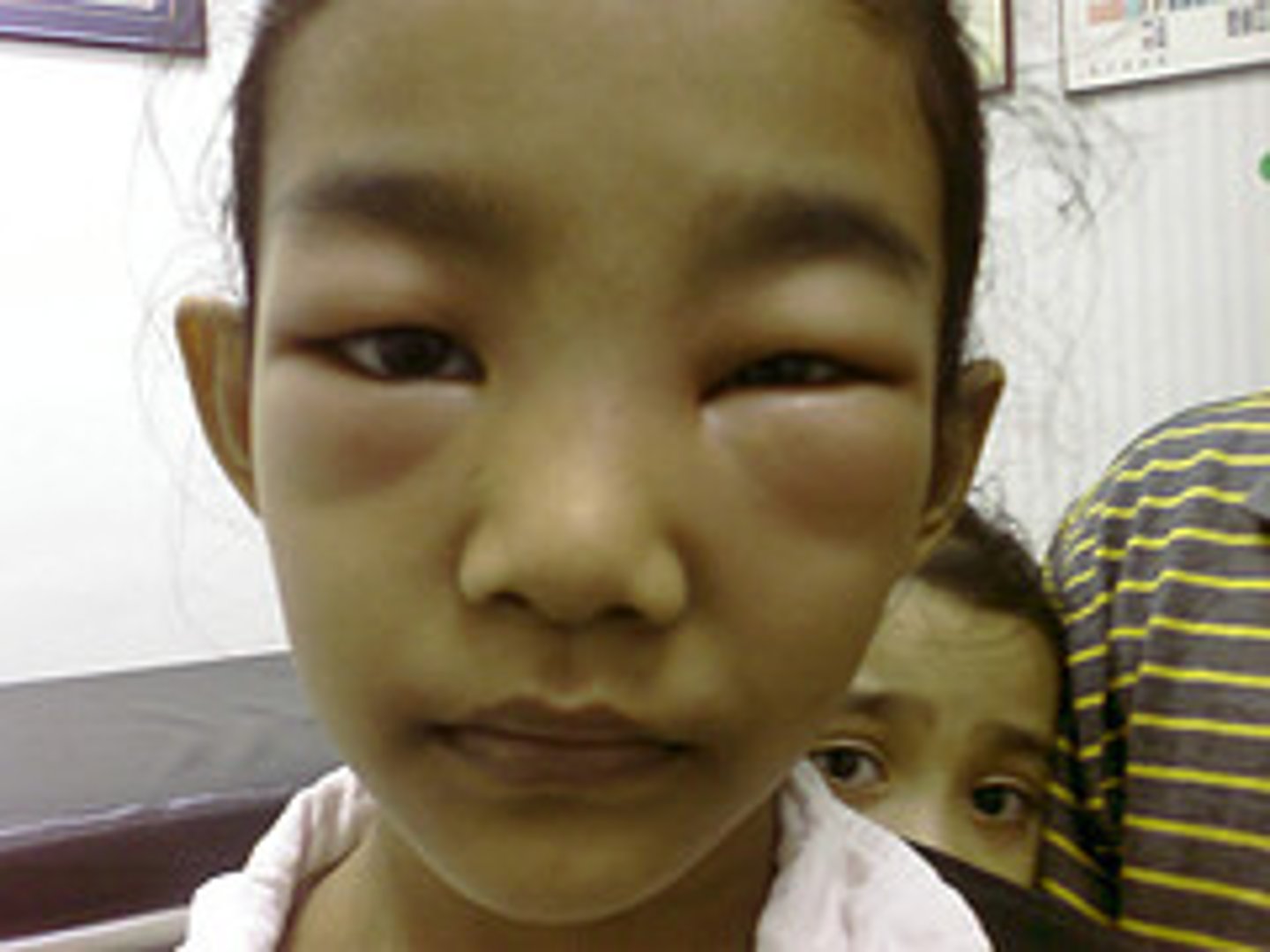 <p>periorbital edema</p><p>puffy, pale face</p><p>swollen lips</p><p>slit like eyes</p><p>occurs in the morning usually</p>