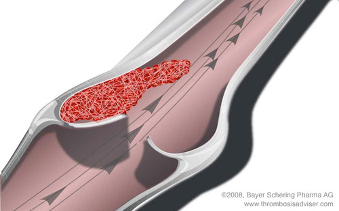 <p>A blood clot that forms in an unbroken blood vessel; if the clot blocks blood circulation --&gt; tissue death will occur</p>