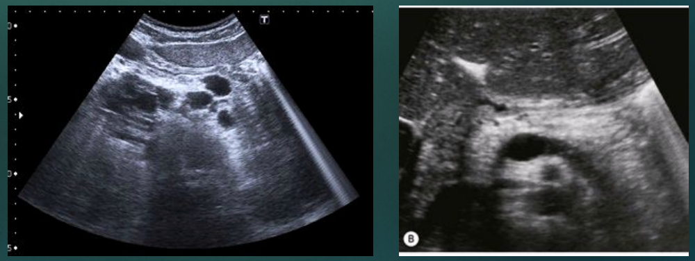 <ul><li><p><span style="background-color: transparent;">Hyperechoic and small pancreas</span></p><ul><li><p><span style="background-color: transparent;">Hypoechoic areas may be present and represent pancreatic fibrosis </span></p></li></ul></li><li><p><span style="background-color: transparent;">Calcifications </span></p></li><li><p><span style="background-color: transparent;">Small cysts </span></p></li><li><p><span style="background-color: transparent;">Gallstones and liver disease common</span></p></li></ul><p></p>