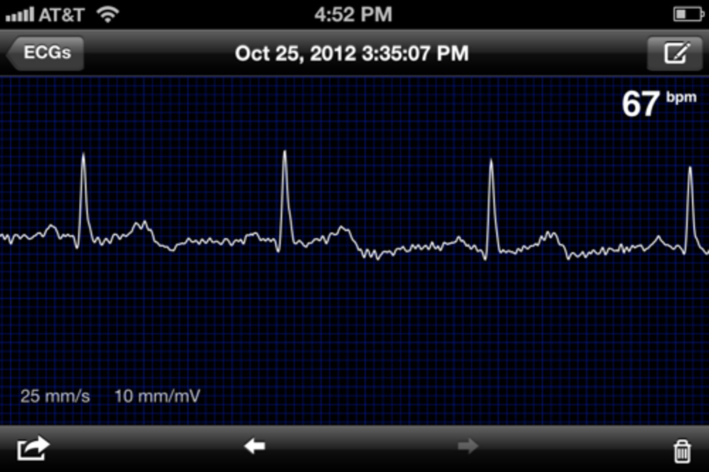 <p>A recording of the electrical activity of the heart</p>