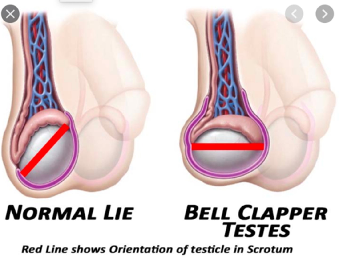 <p>-early: profound testicular swelling</p><p>-12-24 hours: reactive hydrocele and overlying erythema of the scrotal wall</p><p>-often possible to detorse a testis during exam by gentle rotation away from the midline</p><p>-sudden onset of severe pain</p><p>usually starts in scrotum but can be localized to the central or lower abd or the inguinal area</p><p>-N/V</p><p>-most pts report no urinary symptoms</p><p>-affected hemiscrotum is swollen, tender, and firm</p><p>-scrotal skin becomes red and edematous</p><p>-testis is high-rising and in a horizontal lie (bell clapper deformity)</p><p>-testis may be drawn up into the neck of the scrotum, where the cord is palpably thickened</p><p>-cremasteric reflex absent on affected side</p><p>-20% of pts have mild fever</p>