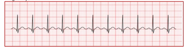 <p>Sinus Tachycardia</p>