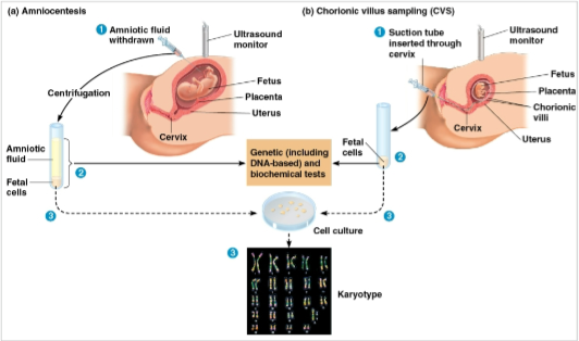 <p>Amniocentesis</p>