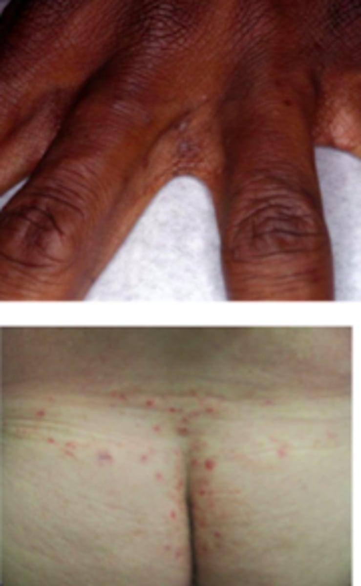 <p>Parasitic ID:</p><p>Subjective:</p><p>- Extreme pruritus</p><p>- Severe and worse at night</p><p>- Delayed-type hypersensitivity reaction to the mite, mite feces, and mite eggs</p><p>- Symptoms occur 3-6 weeks after primary infestation</p><p>- In previously-infested patients, symptoms usually begin within 1-3 days after infestation, presumably because of prior sensitization</p>