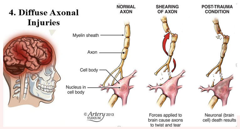 <p>Caused by widespread shearing and rotational forces that create damage throughout the brain and axons in cerebral hemispheres, corpus callosum, and brain stem.</p><ul><li><p>Injury could be diffuse with no identifiable focal lesion.</p></li><li><p><span style="color: yellow"><strong>Prolonged traumatic coma</strong></span>; associated with poor prognosis than focal lesion.</p><ul><li><p>Can also experience <em>decorticate and decerebrate posturing</em>, <em>global cerebral edema</em> in severe cases.</p></li></ul></li><li><p>Recovery is dependent on severity of axonal injury.</p></li><li><p><strong><u>Prognosis</u></strong>:</p><ul><li><p><span style="color: yellow">Dysautonomia</span><span> - common complication; disruptions in autonomic body functions (HR, RR, temperature, BP, sweating, muscle tone, posturing, digesting) – chronic, long-term (baseline)</span></p><ul><li><p><span style="color: yellow">Neurostorming</span><span> – sudden, episodic hyperactivity of the nervous system in possible effort to “reboot brain” post injury but is ineffective</span></p></li></ul></li></ul></li><li><p><strong><u>Medical Management</u></strong>:</p><ul><li><p>Physical and neurological assessments</p></li><li><p>CT, MRI (MRI &gt; CT)</p></li><li><p>PET</p></li><li><p>C-Collar/C-Spine precautions</p></li><li><p><strong>Goal</strong>: to preserve brain homeostasis and prevent any secondary brain injury.</p><ul><li><p>Stabilization of cardiovascular and respiratory function</p></li><li><p>Control of hemorrhage and hypervolemia</p></li><li><p>Maintenance of optimal blood gas values</p></li></ul></li></ul></li></ul><p></p>