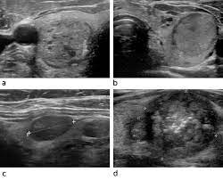 what thyroid pathology is shown here? note: these have a broad range of appearances and most often appear as solitary and homogeneous