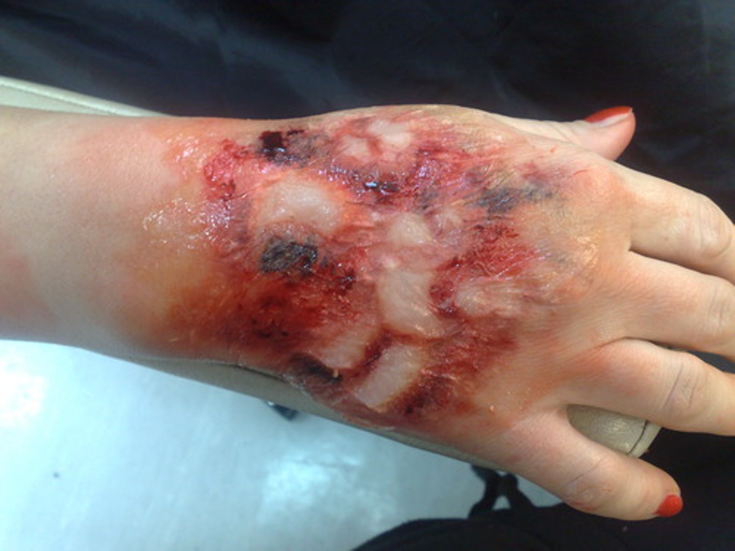 <p>-involve the entire thickness of the skin</p><p>-skin turns grey-white, cherry red, or blackened</p><p>-typically not painful because nerve endings are destroyed</p>