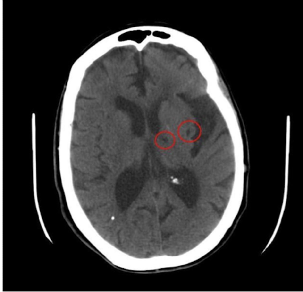 <p>What is the size of small vessel/Lacunar infarcts like?</p>