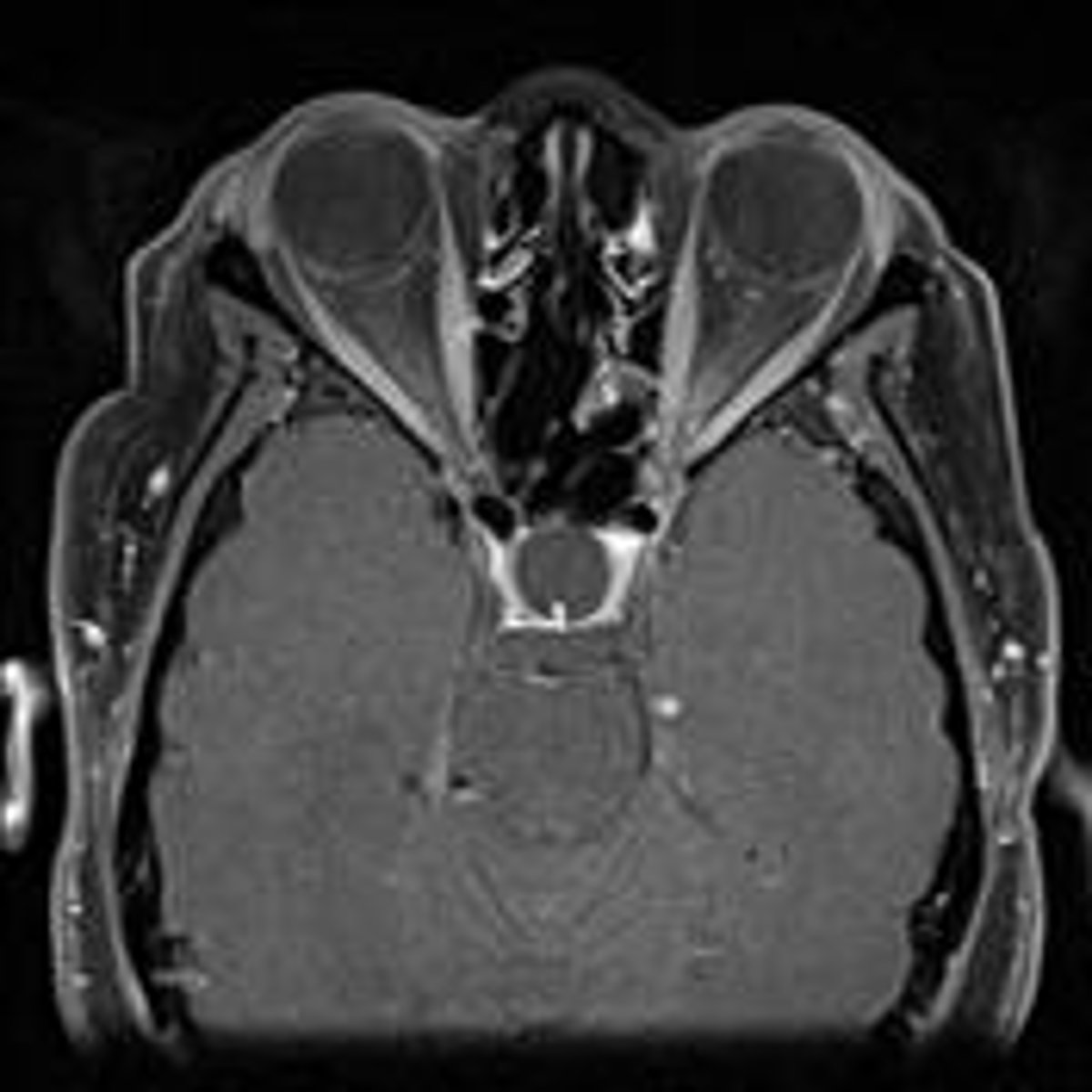 <p>"Infundibulum sign" (pituitary stalk is present, it's just compressed)</p>