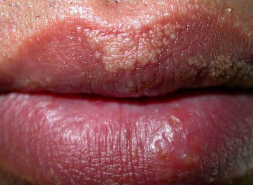 <p>clusters of ectopic sebaceous glands, requires no treatment </p>