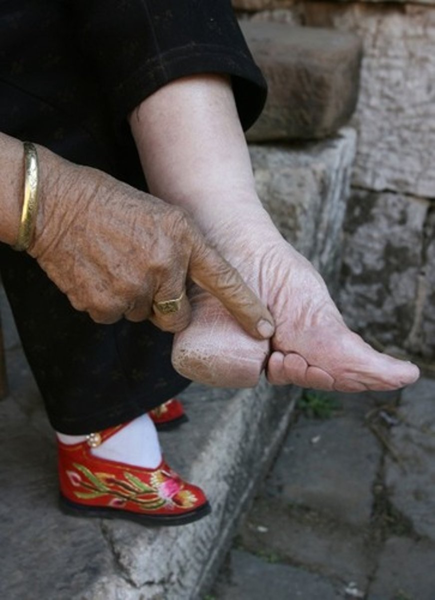 <p>traditional Chinese practice of misshaping the feet of young girls through breaking and binding the foot. Seen as a status symbol in Qing dynasty China</p>