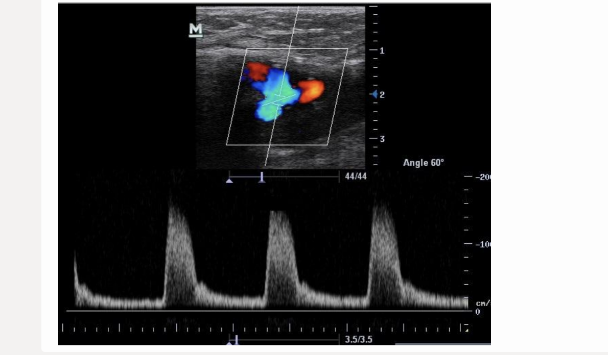 <p>where does the 1st caliper go when measuring acceleration time? click on the 3rd waveform</p><p>.</p><p>[start of 3rd waveform]</p>